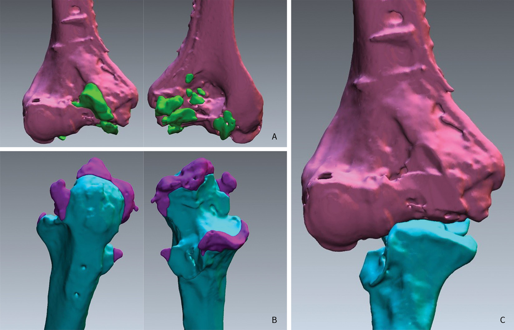 Treatment Of Elbow Stiffness Slovenian Medical Journal